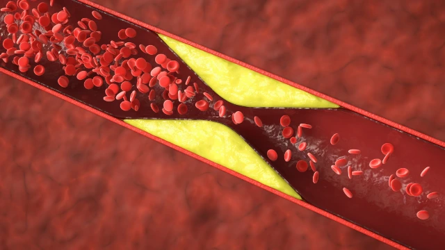 Praktische Tipps zur Reduzierung von Atherosklerose-Risiken